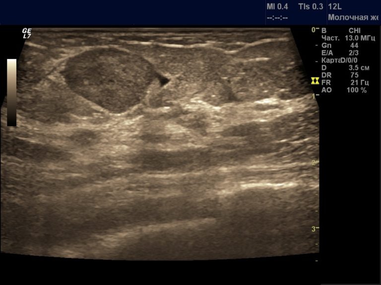 Листовидная фиброаденома молочной железы на узи как выглядит фото