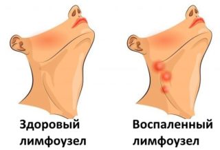 Болит горло и лимфоузлы у ключицы на шее