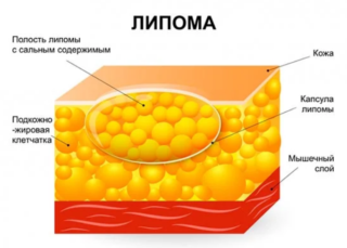 Липома грудной клетки код мкб