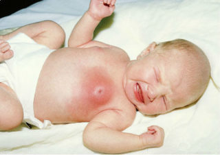 Уплотнение в молочной железе у новорожденной девочки лечение