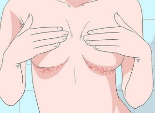 Красные пятна под грудными железами лечение