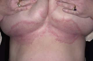 Красные пятна под грудными железами лечение