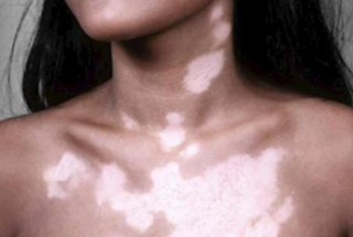 Пятна на груди у женщин: коричневые, желтые, белые