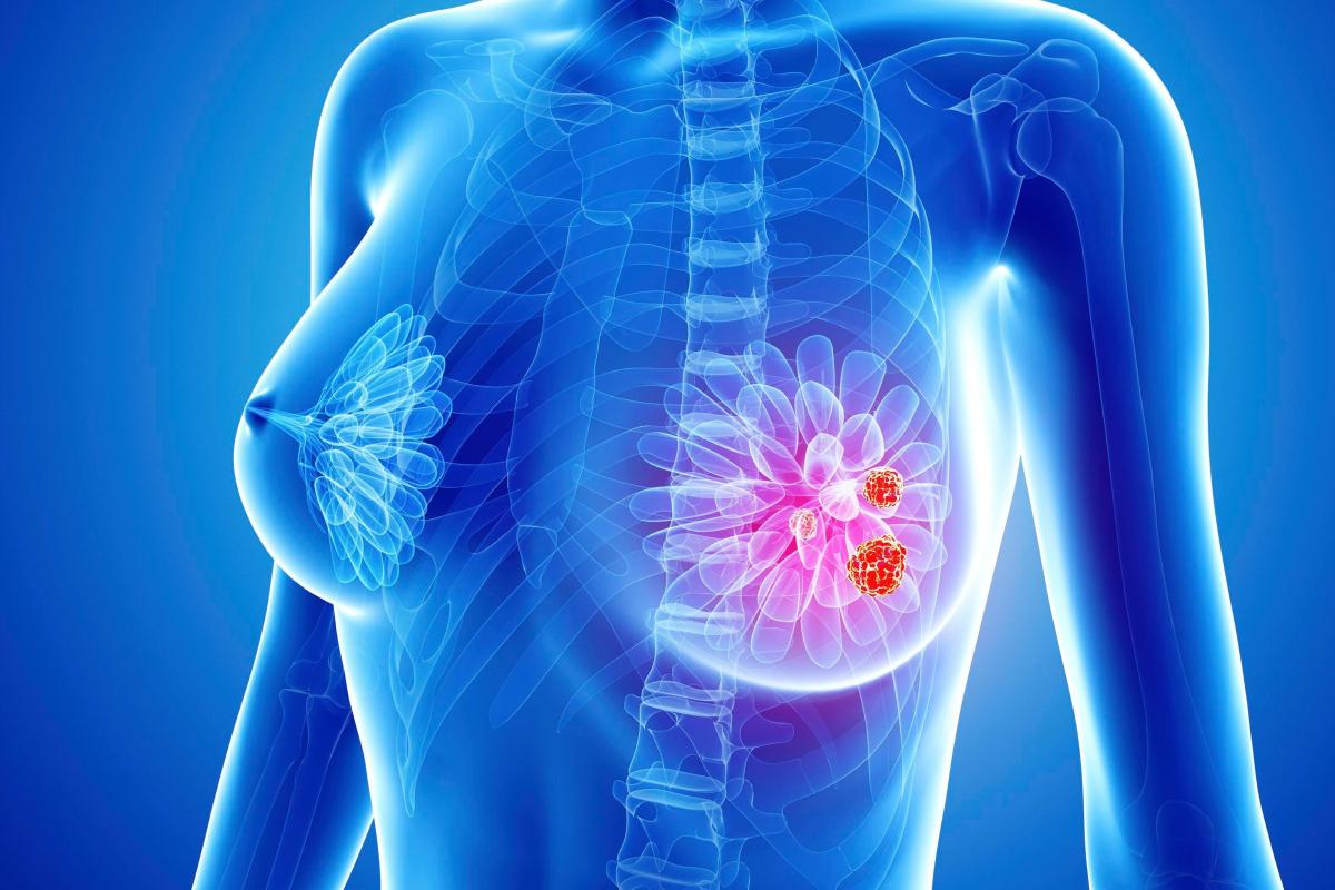доброкачественные опухоли в груди у женщин фото 107