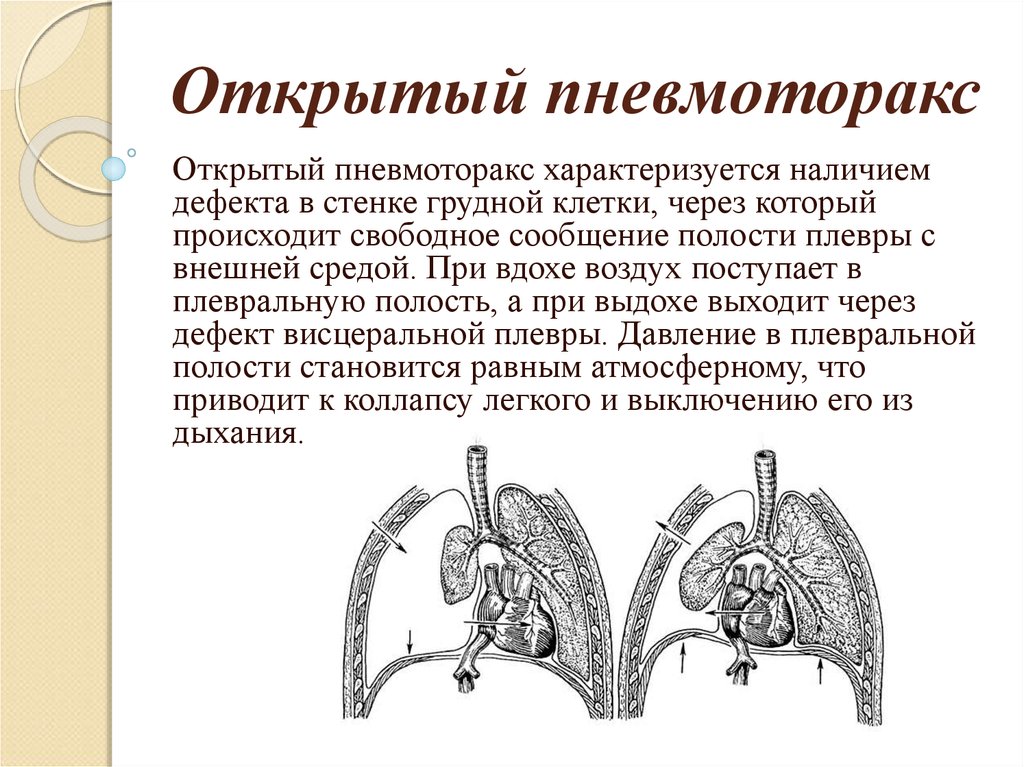 На компьютерной томограмме органов грудной клетки трахея определяется как