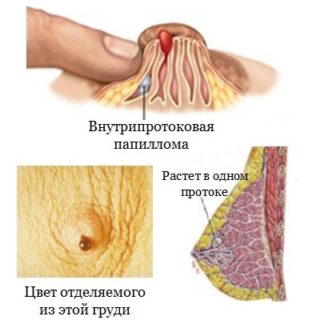 Болезнь минца молочной железы лечение народными средствами отзывы thumbnail