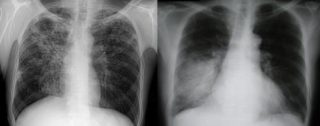 Рентген грудной клетки и флюорография: отличие и схожесть методов