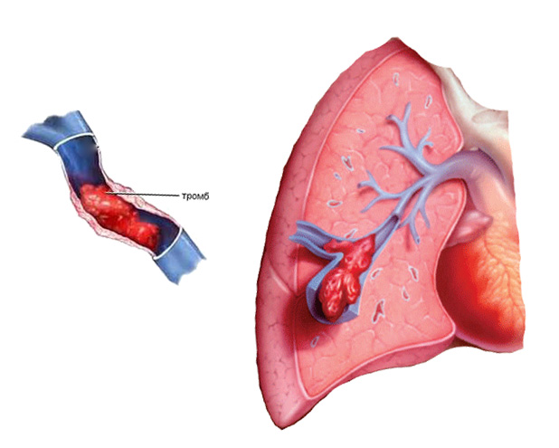 Тромбоэмболия артерии миокарда. Массивная тромбоэмболия. Тромбоэмболия легочной артерии. Тромбофлебит легочной артерии. Тромб в легочной артерии.