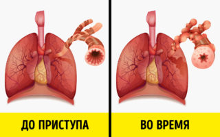 Заложенность в грудной клетке сухой кашель