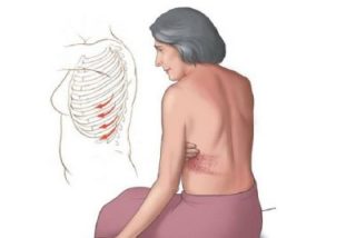 Болят мышцы спины где ребра