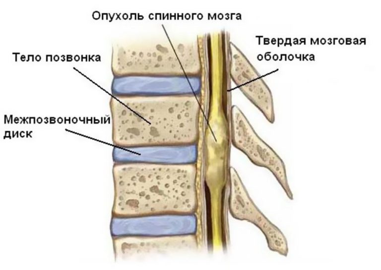 Где находится спинной мозг у человека фото признаки и лечение