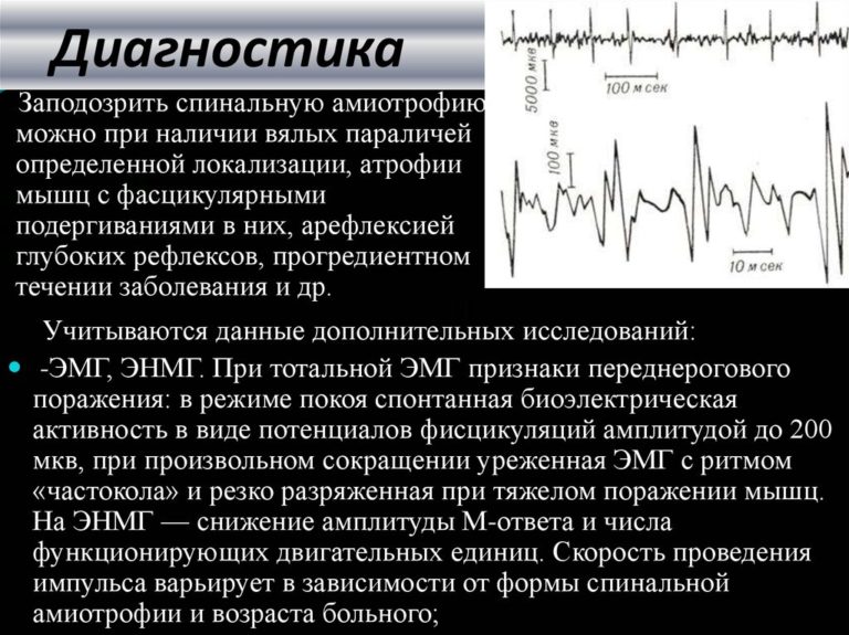 Спинальная мышечная атрофия презентация