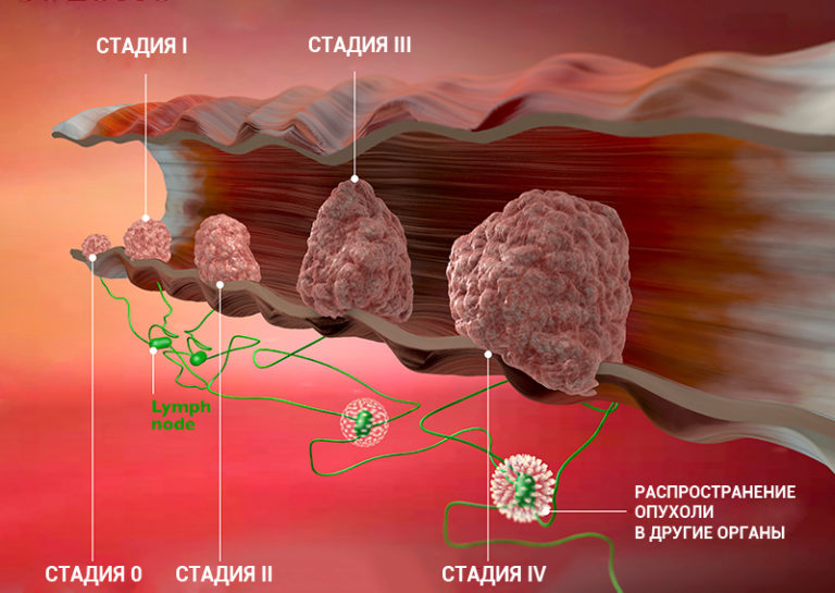 Стадия ib tnm7 что это такое