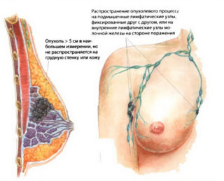Рак молочной железы tnm