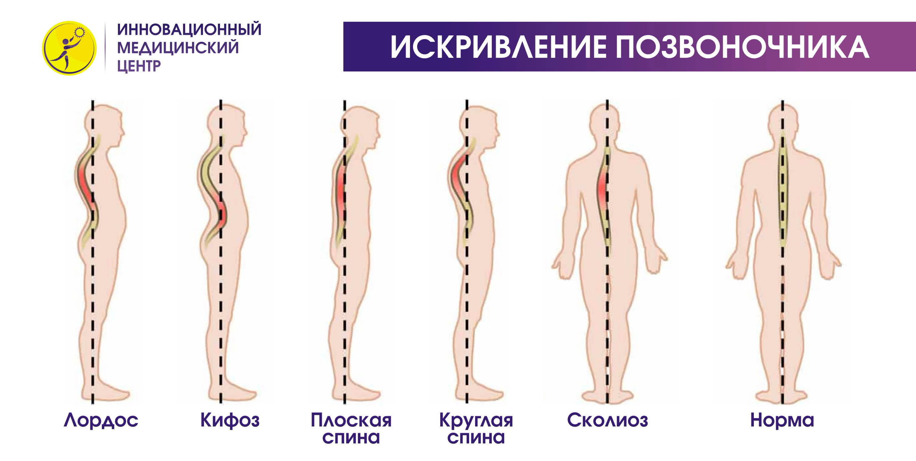 Виды искривления позвоночника у взрослых фото