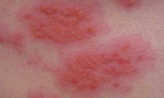 Аллергия на спине у ребенка от чего и как лечить