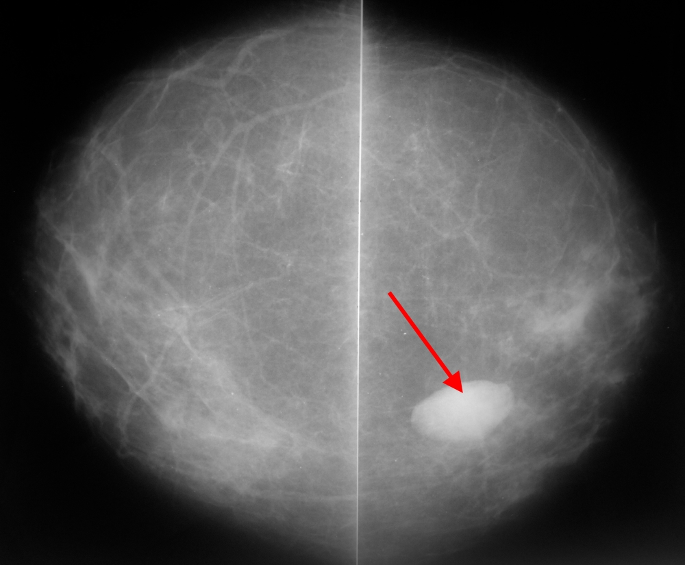 Как выглядит киста молочной железы на маммографии фото