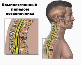 Отек спинного мозга позвоночника как лечить thumbnail