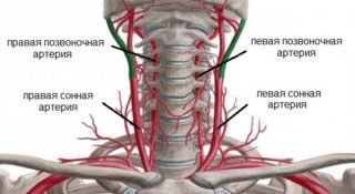 Гипоплазия правой позвоночной артерии код мкб