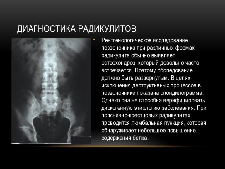 Радикулопатия карта вызова