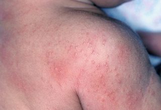 Аллергия на спине у подростка