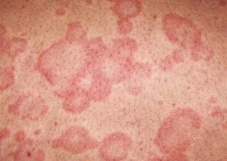 Проявление аллергии у детей на спине