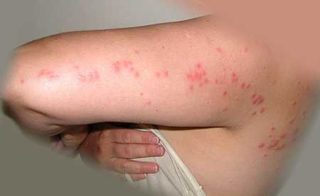Аллергия на спине у ребенка чем лечить