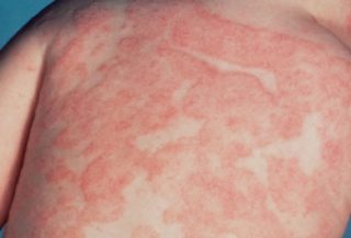 Проявление аллергии у детей на спине