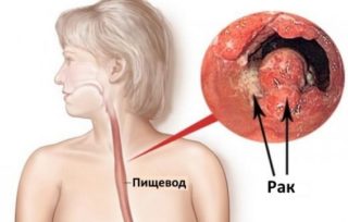 Боль в груди справа - причины, диагностика и лечение