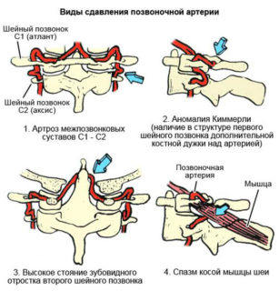 Синдром позвоночной артерии при шейном остеохондрозе мкб