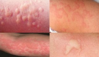 Аллергия на спине у подростка thumbnail