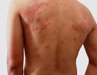Атопический дерматит на спине как лечить