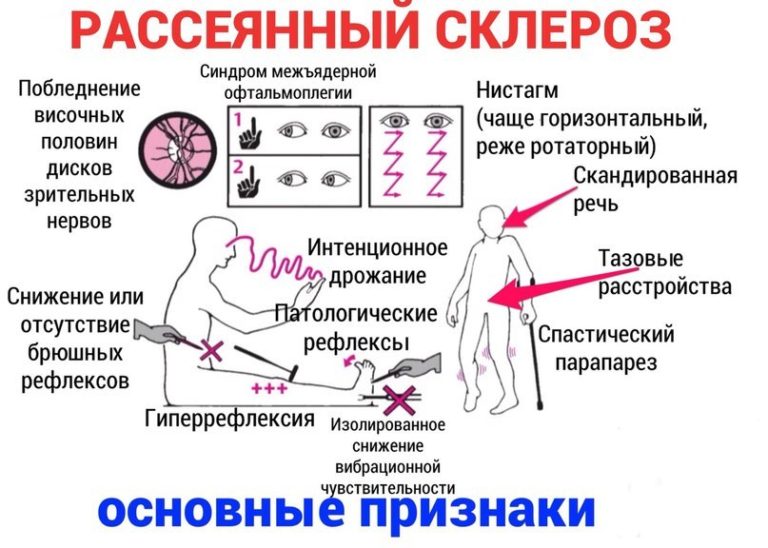 Гимнастика при рассеянном склерозе с картинками