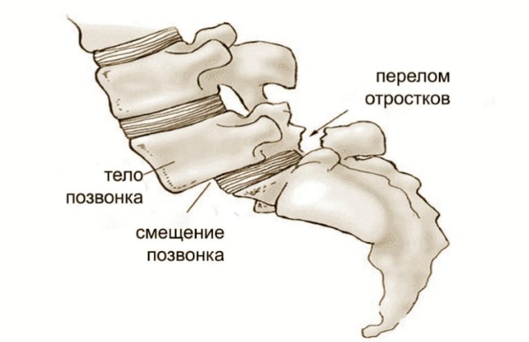 Схема позвонков поясничного отдела