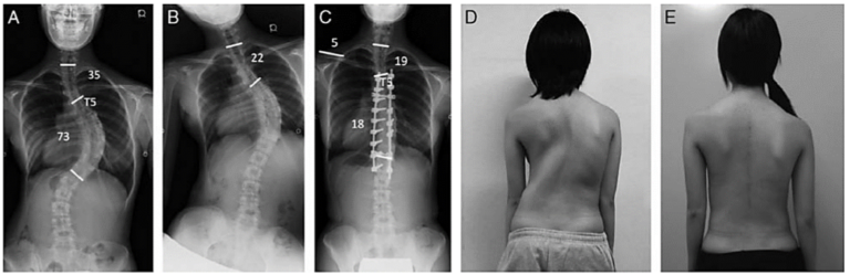 Последняя стадия сколиоза фото