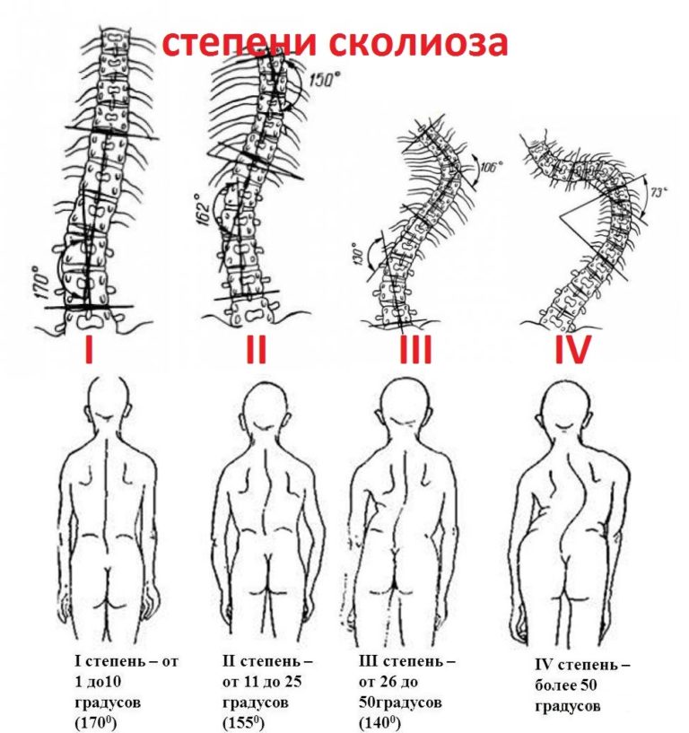 Кифоз шеи фото