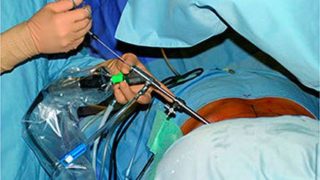 Эндоскопическая операция по удалению грыжи позвоночника реабилитация