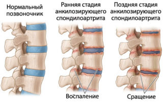 Боль в спине в области позвоночника чуть ниже лопаток