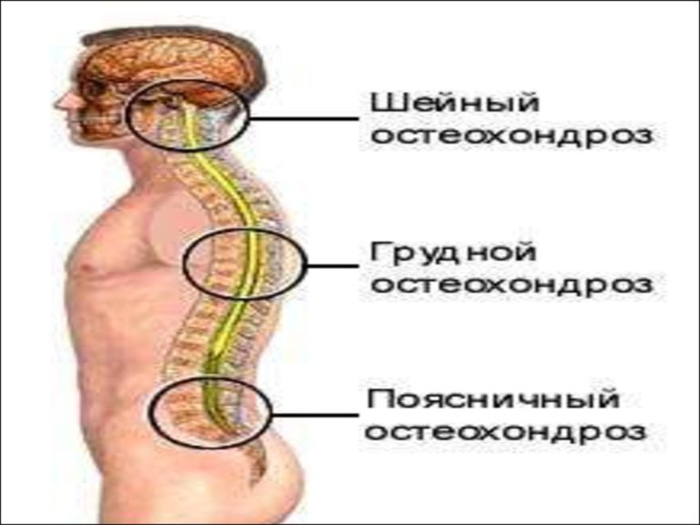 Остеохондроз позвоночника мкб