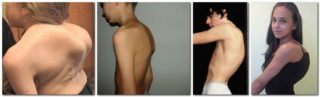 Как избавиться от горба на спине: массаж, специальный комплекс упражнений, регулярные занятия, показания и противопоказания