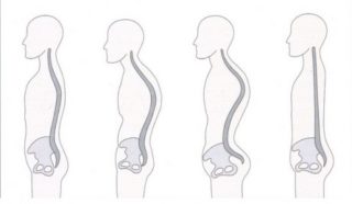 Синдром прямой спины как лечить
