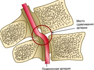 Гипертонус мышцы поясничного отдела