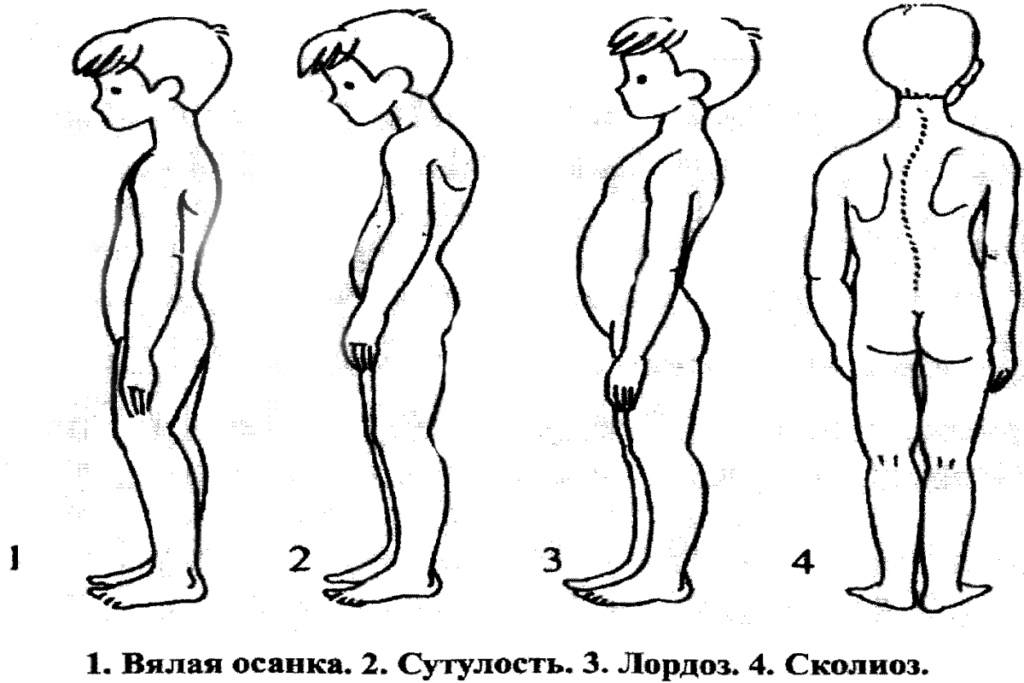 Фото лордоз у детей