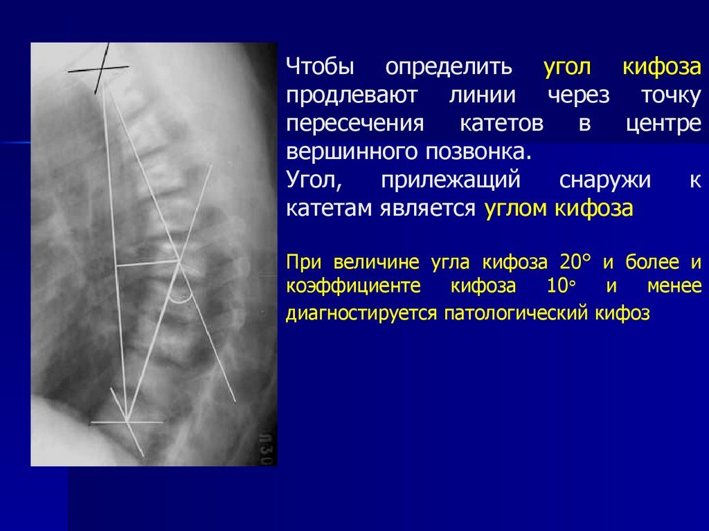 Степени грудного кифоза. Грудной кифоз угол Кобба. Степени кифоза по чаклину. Степень искривления позвоночника кифоз. Угол кифоза грудного отдела позвоночника.