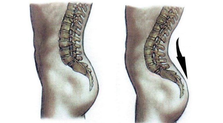 Поясничный лордоз фото