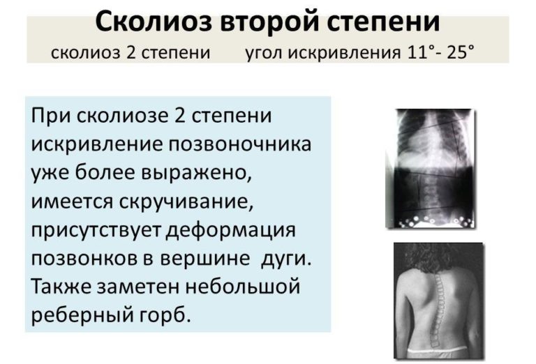 Сколиоз 1 степени ввк мвд какая группа