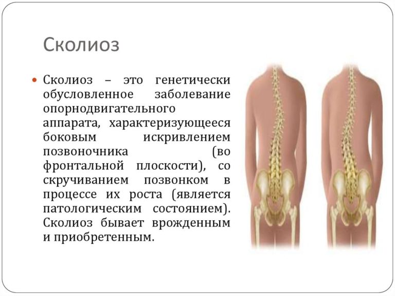 Левосторонний сколиоз фото