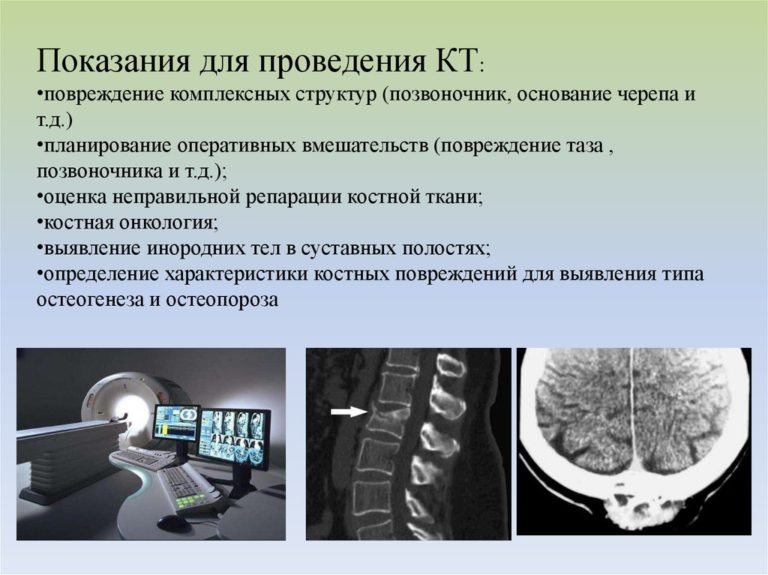 Компьютерная томография грудного отдела что показывает