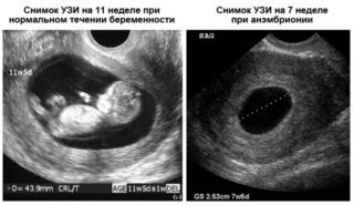 Болит поясница перед месячными может ли быть беременность thumbnail