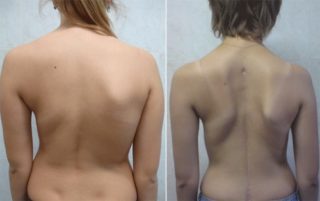 ЛФК при сколиозе у детей: комплекс упражнений в домашних условиях при разных стадиях патологии
